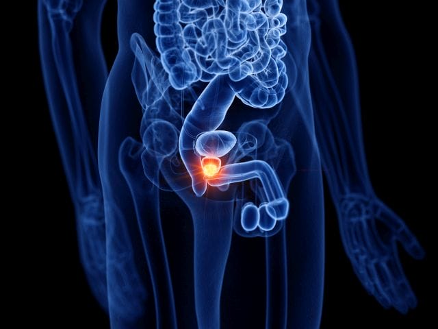 3D-Illustration von Prostatakrebs, bei dem jetzt ein Durchbruch der Präzisions-Onkologie gelungen ist.