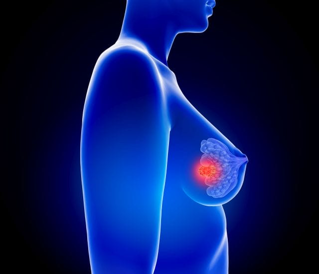 3D-Illustration einer weiblichen Person von der Seite mit hervorgehobener Anatomie der weiblichen Brust inklusive Tumor.