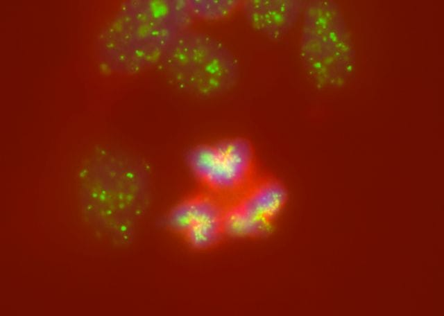 Das Bild zeigt die aus dem Ruder laufende Zellteilung von Neuroblastomzellen mit mehreren Spindelpolen und Spindelapparaten.