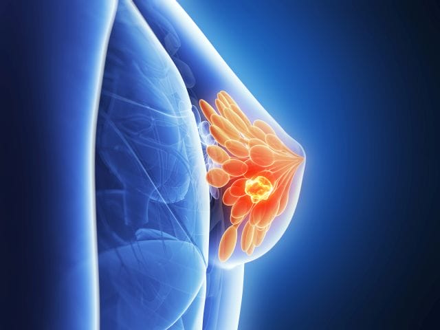 3D-Illustration der weiblichen Brust mit bunt hervorgehobenem Drüsengewebe sowie Tumor.
