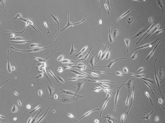 Das Bild zeigt frisch isolierte Glioblastomzellen eines Patienten in der Zellkultur (400-fache Vergrößerung).