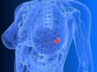 3D-illustration der Anatomie des weiblichen Oberkörpers mit bunt hervorgehobenem Tumor in einer Brust.