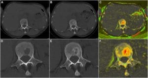 Computertomographische Aufnahmen einer 62-jährigen Patientin mit Multiplem Myelom mit Knochendefekten im ersten Lendenwirbel.